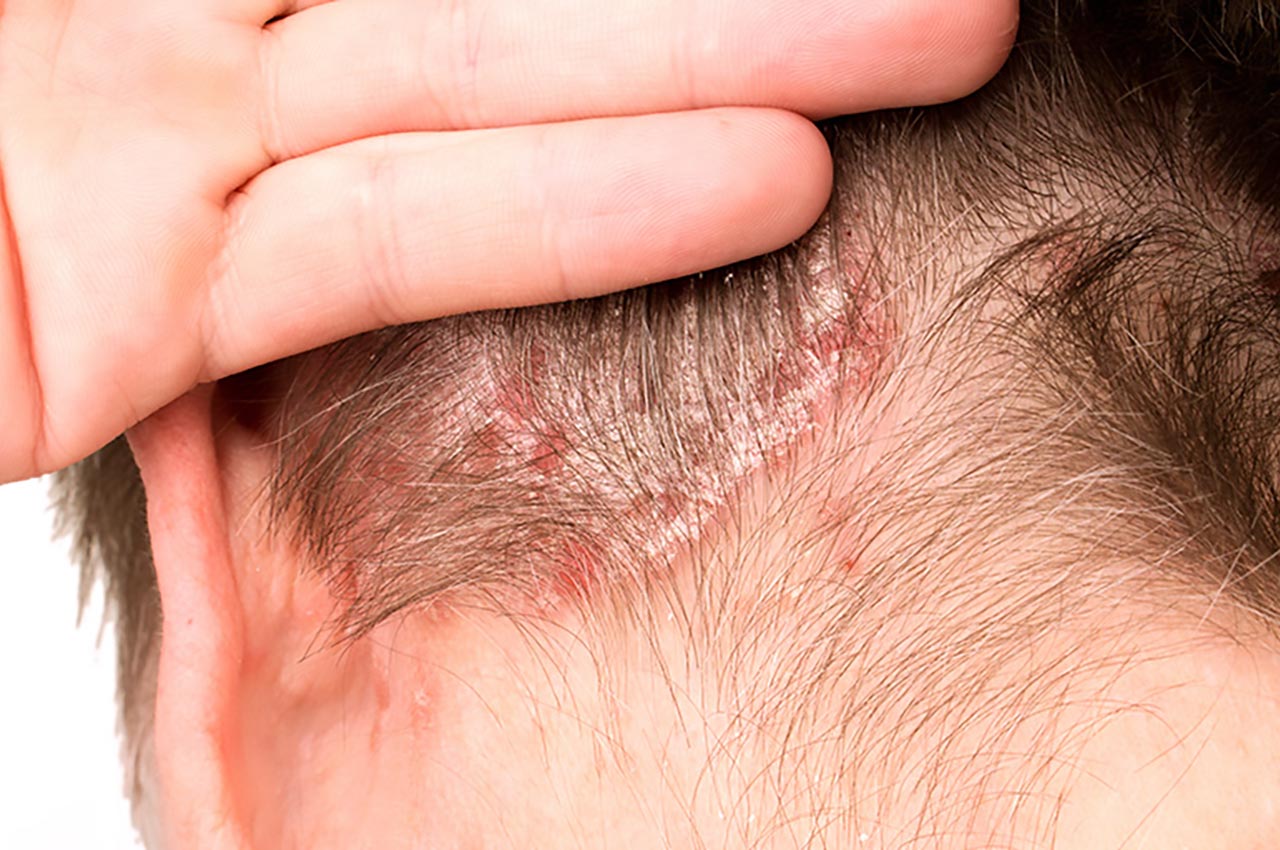 Dermatite Seborreica: causas, sintomas, tratamentos e prevenção