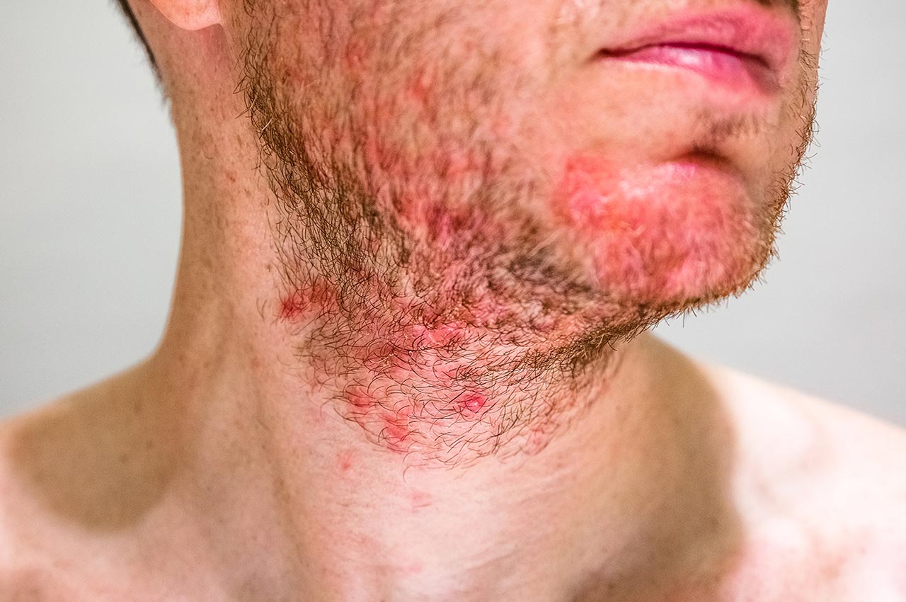 Foliculite: causas, sintomas, prevenção e tratamentos disponíveis