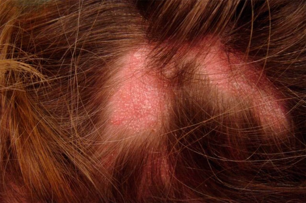 Líquen Plano Pilar: quando a inflamação causa calvície cicatricial