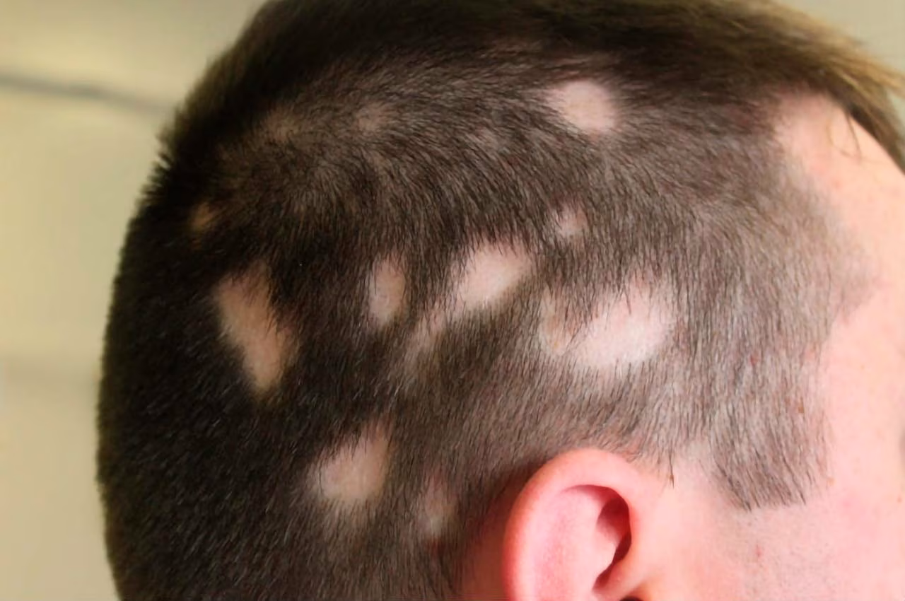 Foliculite Decalvante: como a tricologia pode ajudar no tratamento